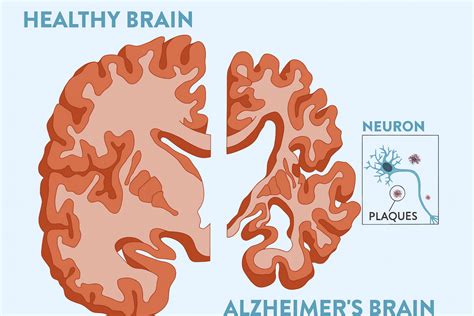 Hliník a Alzheimerova choroba: výskum a hypotézy