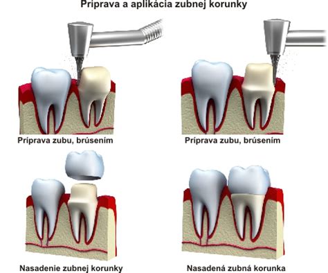 Schéma zirkónovej korunky na zube