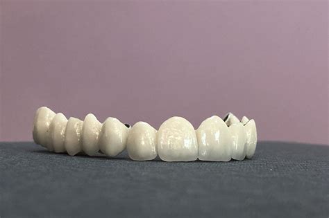 Porovnanie zirkónovej a kovokeramickej korunky