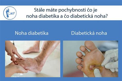 Prehľad komplikácií diabetickej nohy