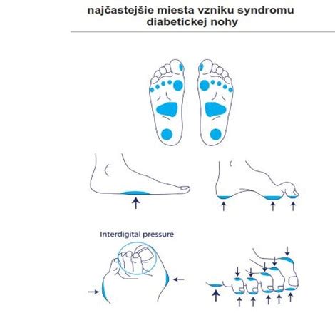 Porovnanie neuropatických a ischemických vredov na diabetickej nohe