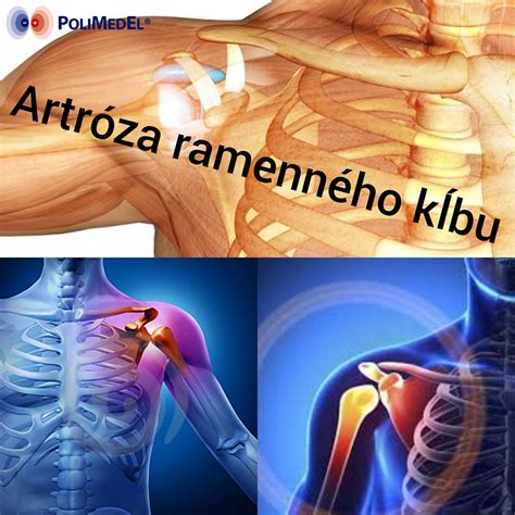 Infografika: Anatomická štruktúra zdravého kĺbu a kĺbu postihnutého artritídou