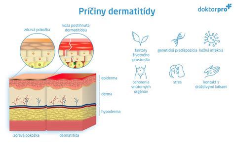 Ilustrácia atopickej dermatitídy a upokojujúci obklad