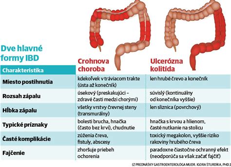 Infografika: Zápalové ochorenia čriev (IBD)