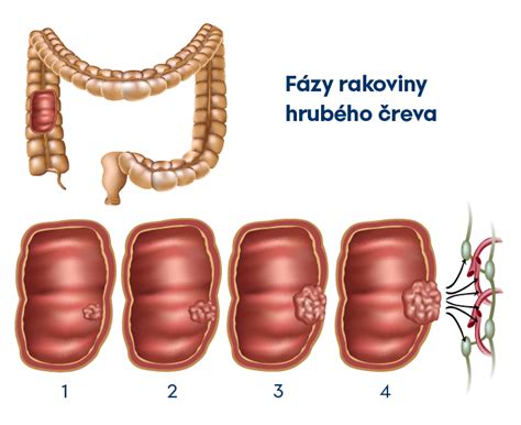 Schéma liečebných možností rakoviny hrubého čreva