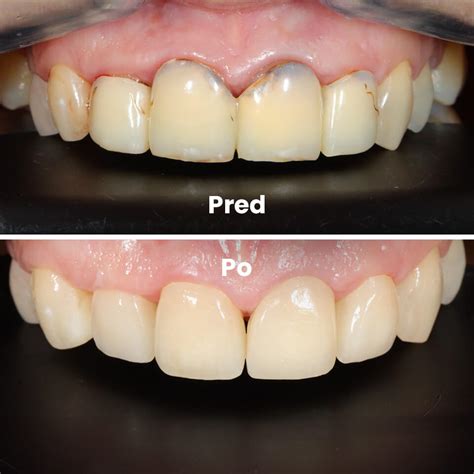 Zubné korunky a mostíky upevnené dentálnym cementom