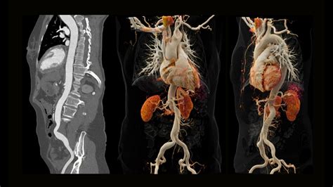 CT angiografia aorty