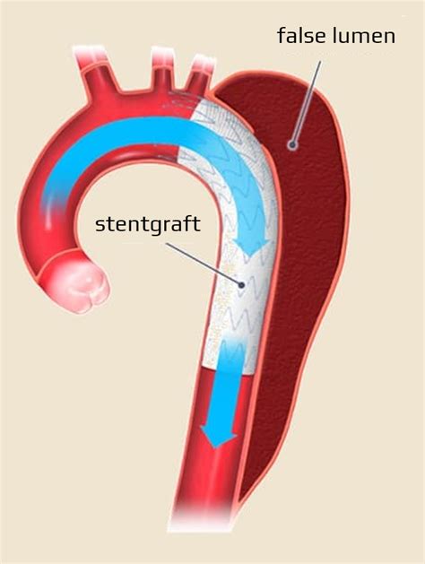 Nový polymérový stentgraft