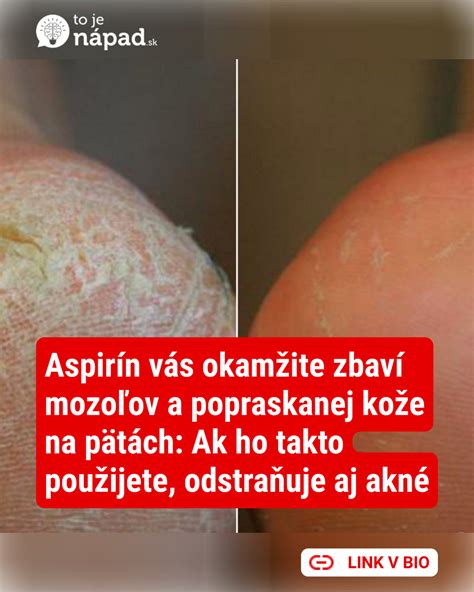 Problém stvrdnutej kože na pätách