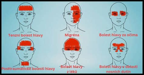 Inhalácia octovej pary pri bolesti hlavy