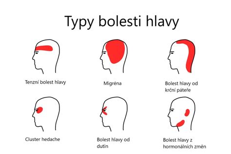 Schéma rozdelenia typov bolesti hlavy na primárne a sekundárne