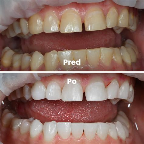 Porovnanie prirodzeného zuba a CEREC korunky