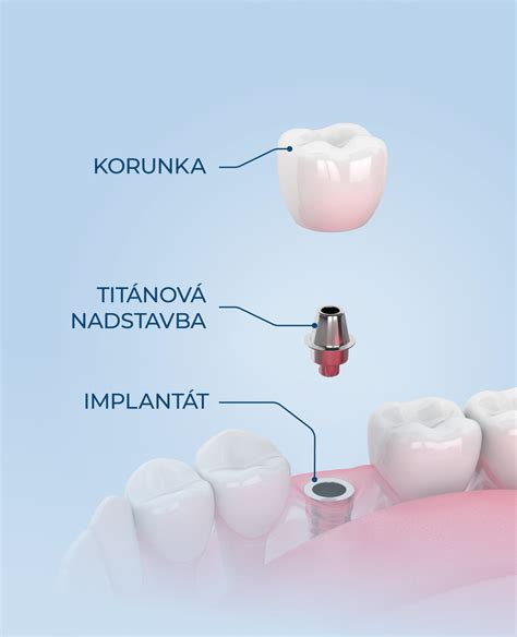 Diagram zubného implantátu v kosti