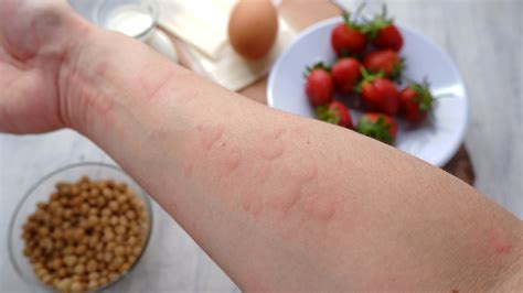 Schéma alergickej reakcie na bodnutie hmyzom