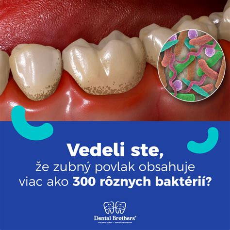 Schéma umiestnenia ortodontických zámkov a drôtikov na zuboch