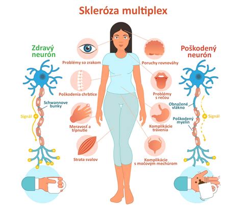 Schéma: Typické oblasti tela postihnuté seboroickou dermatitídou