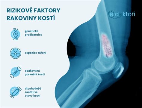 Infografika zobrazujúca rizikové faktory rakoviny žalúdka