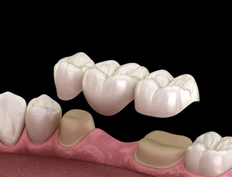 Zubná korunka CEREC na implantáte