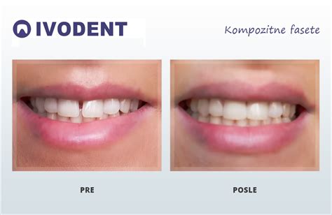 Porovnanie keramických a kompozitných faziet