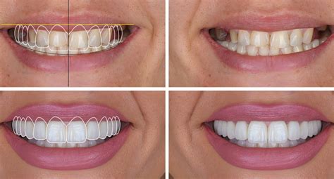 Digital Smile Design: Návrh úsmevu