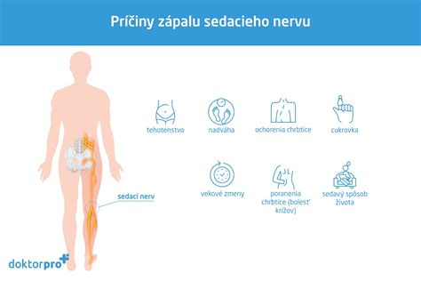 Schéma anatomického uloženia sedacieho nervu v oblasti sedacieho svalu