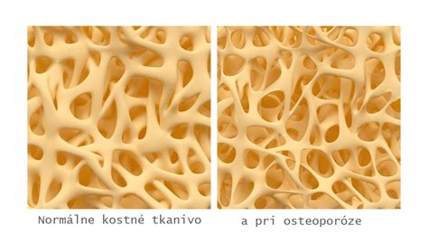 schéma hojenia kostného tkaniva