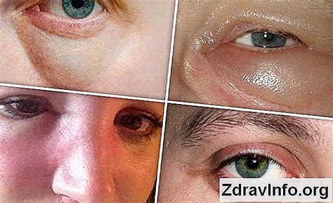 Opuch tváre pri akútnom zápale okostice