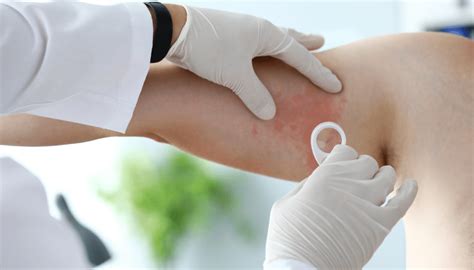 Závažná alergická reakcia po uštipnutí hmyzom