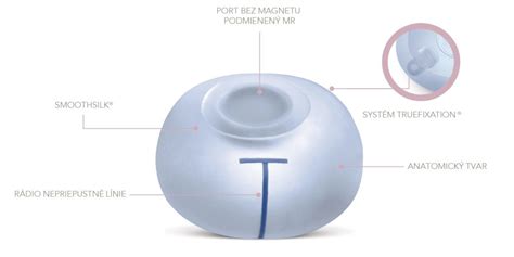 Schéma umiestnenia expandera a následného implantátu pri rekonštrukcii prsníka