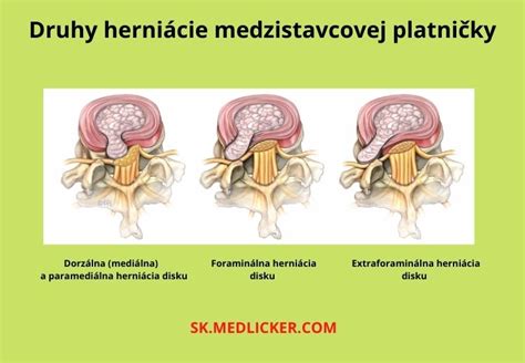 Schéma medzistavcovej platničky a jej štruktúry