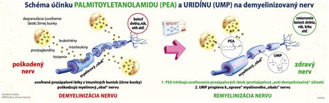 Infografika zobrazujúca rôzne spôsoby liečby útlaku nervu