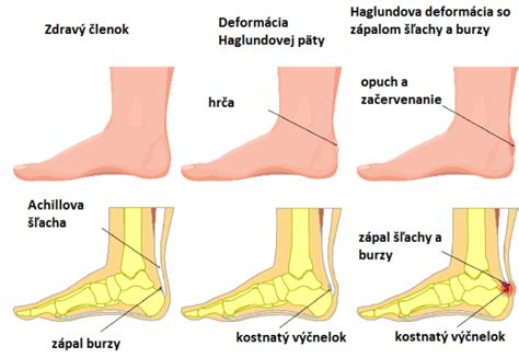 Röntgenová snímka päty s pätovou ostrohou (plantárnou fascitídou)
