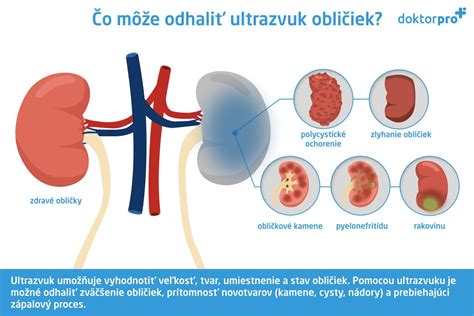 Ilustrácia umiestnenia obličiek a močového systému
