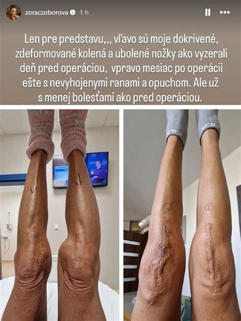 Pacient po operácii kolena na rehabilitácii